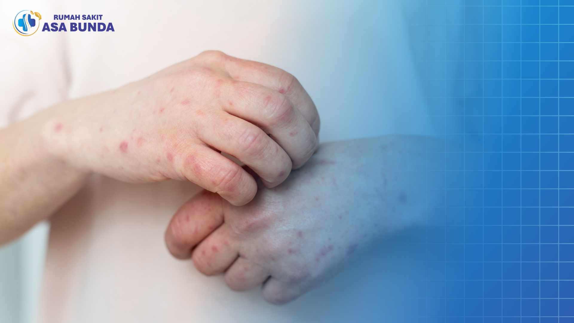 Kasus Campak Meningkat, Kenali Gejala dan Cara Pencegahannya Sejak Dini